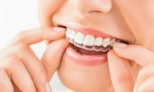 Everything You Need to Know About Invisalign Dentists
